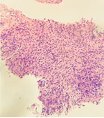 Ultrasound-guided biopsy image of spleen of 79-year-old man with chronic obstructive pulmonary disease and large B-cell lymphoma who had disseminated Nocardia ignorata infection, United States. Tissue fragment shows extensive necrosis with a small focus of large B-cell lymphoma. Neoplastic cells stain positively for CD20 antibody, paired box protein 5, and B‑cell lymphoma 2, with 20% expression of myelocytomatosis oncogene, corroborating the diagnosis of disseminated Nocardia ignorata infection. Mindbomb‑1 antibody is positive in 90% of the cells. Acid-fast, Fite–Faraco, Gomori methenamine silver, and periodic acid–Schiff special stains do not demonstrate identifiable microorganisms or microbiota. Original magnification × 20.