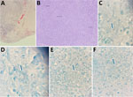 Brain tissue images from 79-year-old man with chronic obstructive pulmonary disease and large B-cell lymphoma who had disseminated Nocardia ignorata infection, United States. A, B) Parenchyma with identifiable granulation tissue, neutrophils, and histocytes and background hemorrhage and necrosis are seen. Hematoxylin and eosin stain; original magnification ×10. C–F) Thin, filamentous, partially acid-fast rods with a beaded appearance within the necrotic tissue background are visible. Branching within visualized organisms was not identified. Arrows indicate N. ignorata bacteria. Fite–Faraco stain; original magnification × 100.