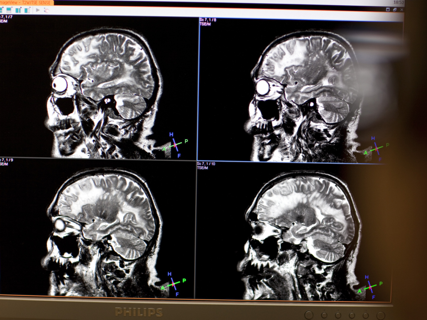 Geneva researchers find new approach to combat schizophrenia symptoms
