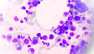 Largest Immune Cell Atlas of Multiple Myeloma Predicts Recurrence Risk
