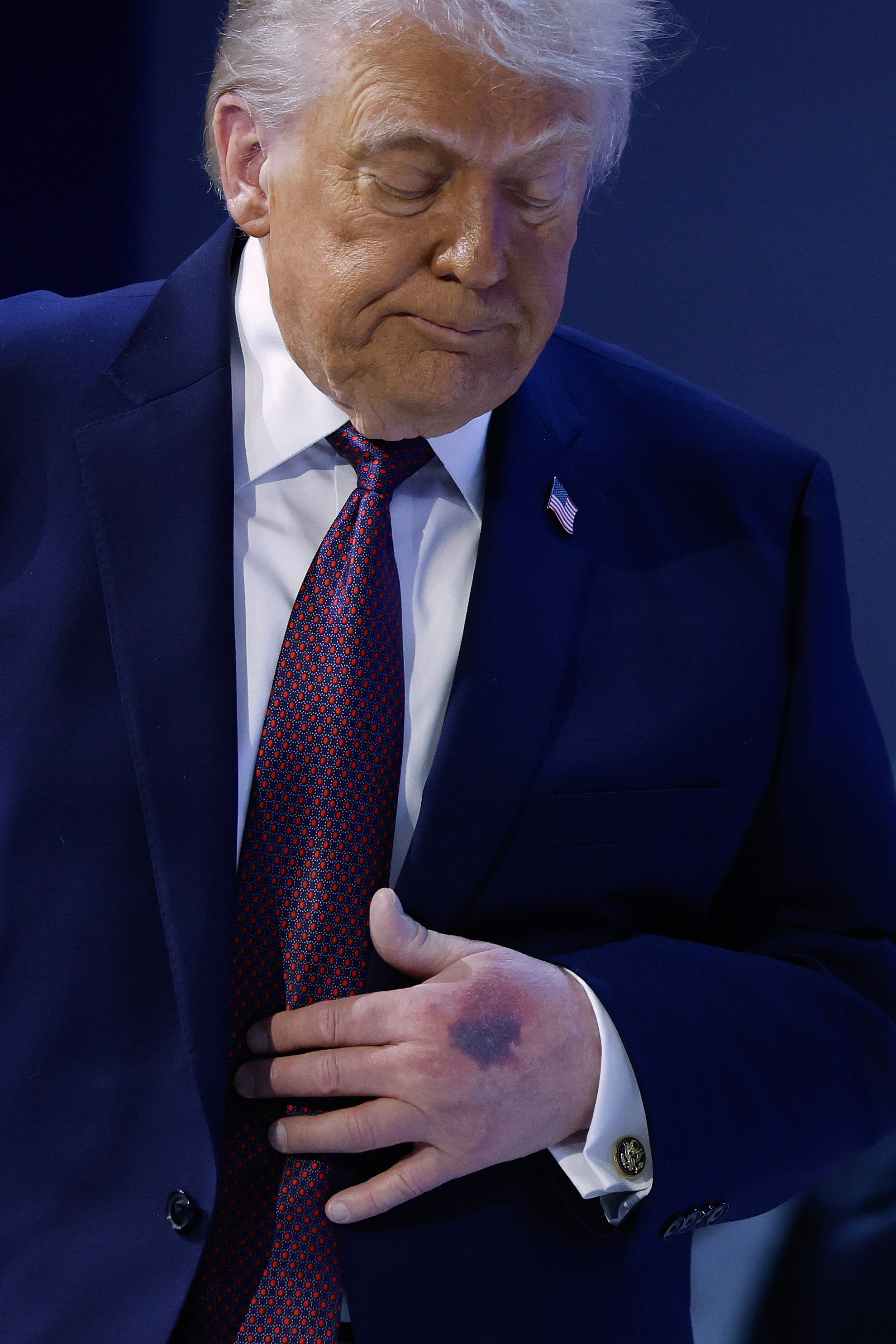 The bruising to Trump’s left hand was prominent in photos taken on Thursday at the World Economic Forum
