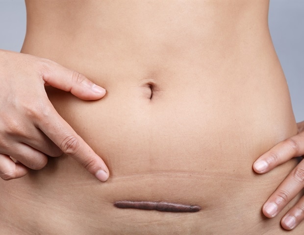 Irregular collagen in uterine scars linked to placenta accreta development