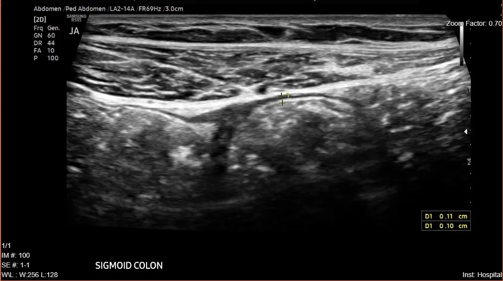 Measurement of bowel wall thickness in a patient with inflammatory bowel disease using intestinal ultrasound