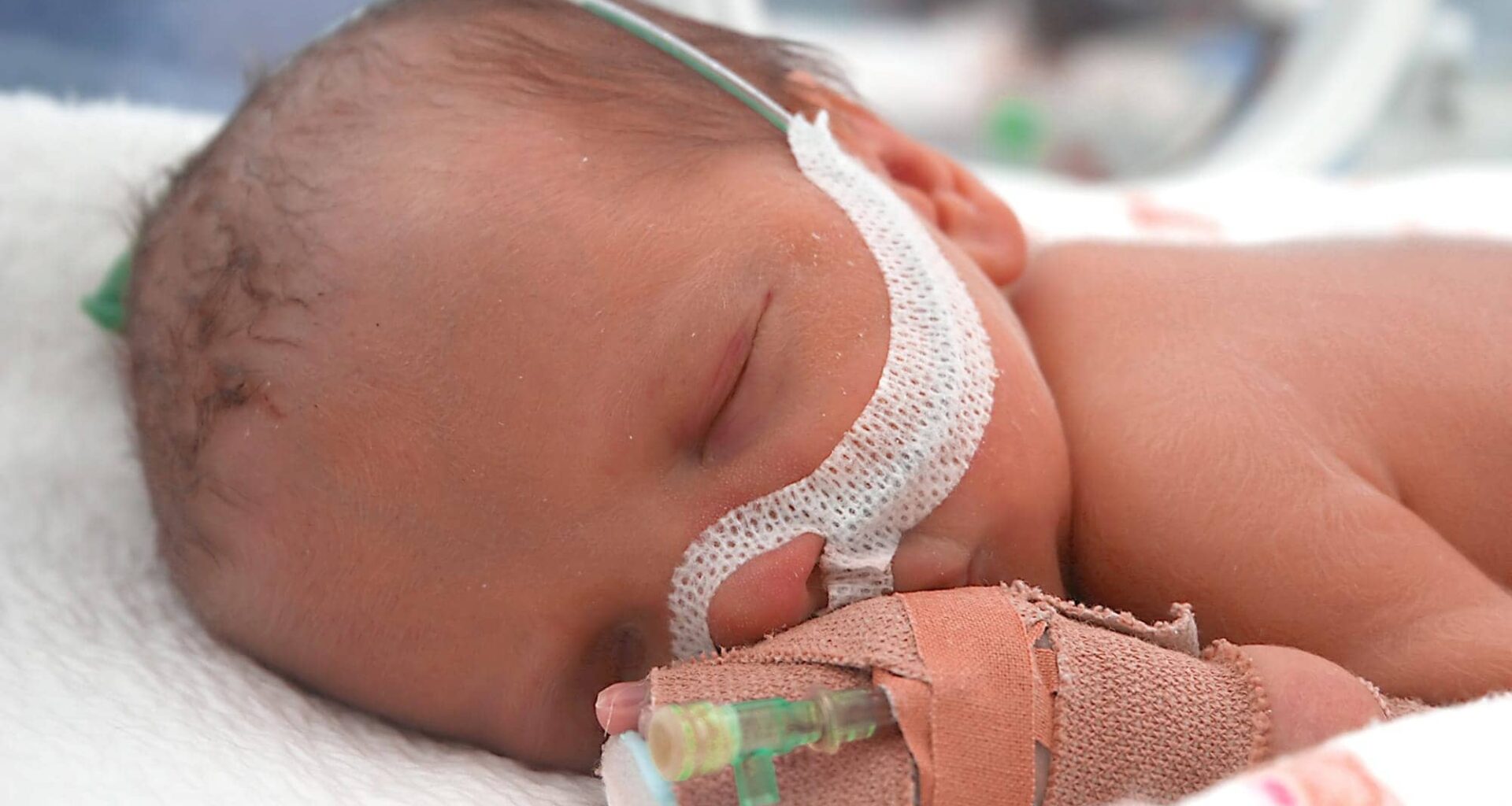 Sleep Breathing Disruptions in Newborns with Severe Spina Bifida