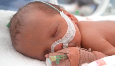 Sleep Breathing Disruptions in Newborns with Severe Spina Bifida