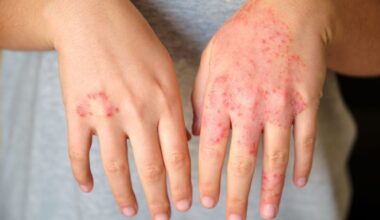 New data links eczema to inflammatory bowel and eye conditions