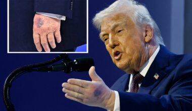 Huge bruise spotted on Trump’s other hand as he delivers speech in Davos