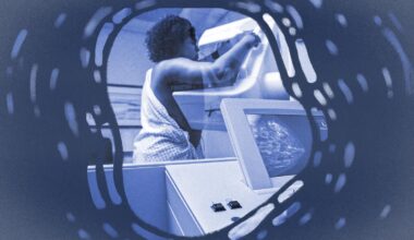 Breast cancer detection depends on mammograms. They don’t work for women like me.