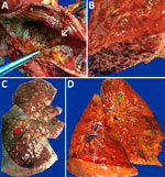 Macroscopic images of respiratory tract from patients with fatal yellow fever, São Paulo, Brazil, 2017–2019. A) Hemorrhagic necrosis of tracheal mucosa, covered with a thick whitish exudate (arrow), caused by Candida spp. invasive infection. B) Petechial pleural hemorrhage. C) Intense parenchymal edema and hemorrhage in the right lung, with massive gastrointestinal content aspiration in the posterior side (red arrow). D) Right lung with icterus, edema, hemorrhage, perivascular hemorrhage (blue arrow), and whitish exudate within bronchus (green arrow) caused by Aspergillus spp. infection.