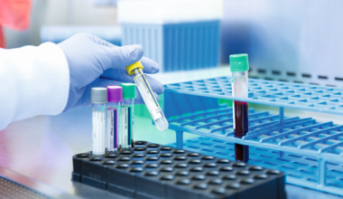 Health-economic analysis evaluates TB infection screening strategies among people living with HIV in Thailand