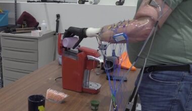 Implanted electrodes provide intuitive control of prosthetic hand – Physics World