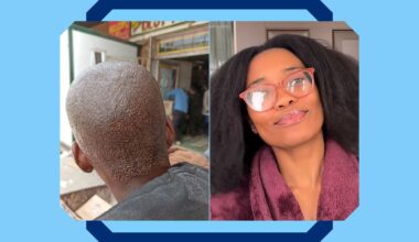 A Lifelong Journey to Fix Seborrheic Dermatitis