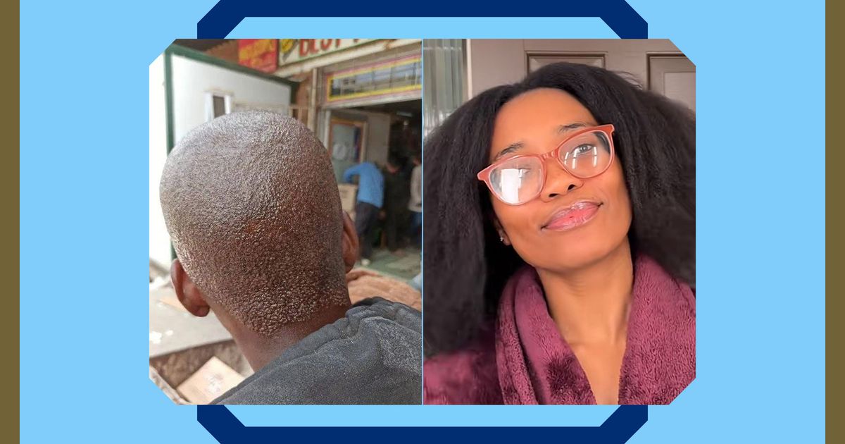 A Lifelong Journey to Fix Seborrheic Dermatitis