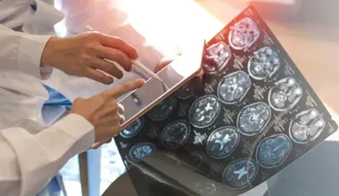 multiple sclerosis MS