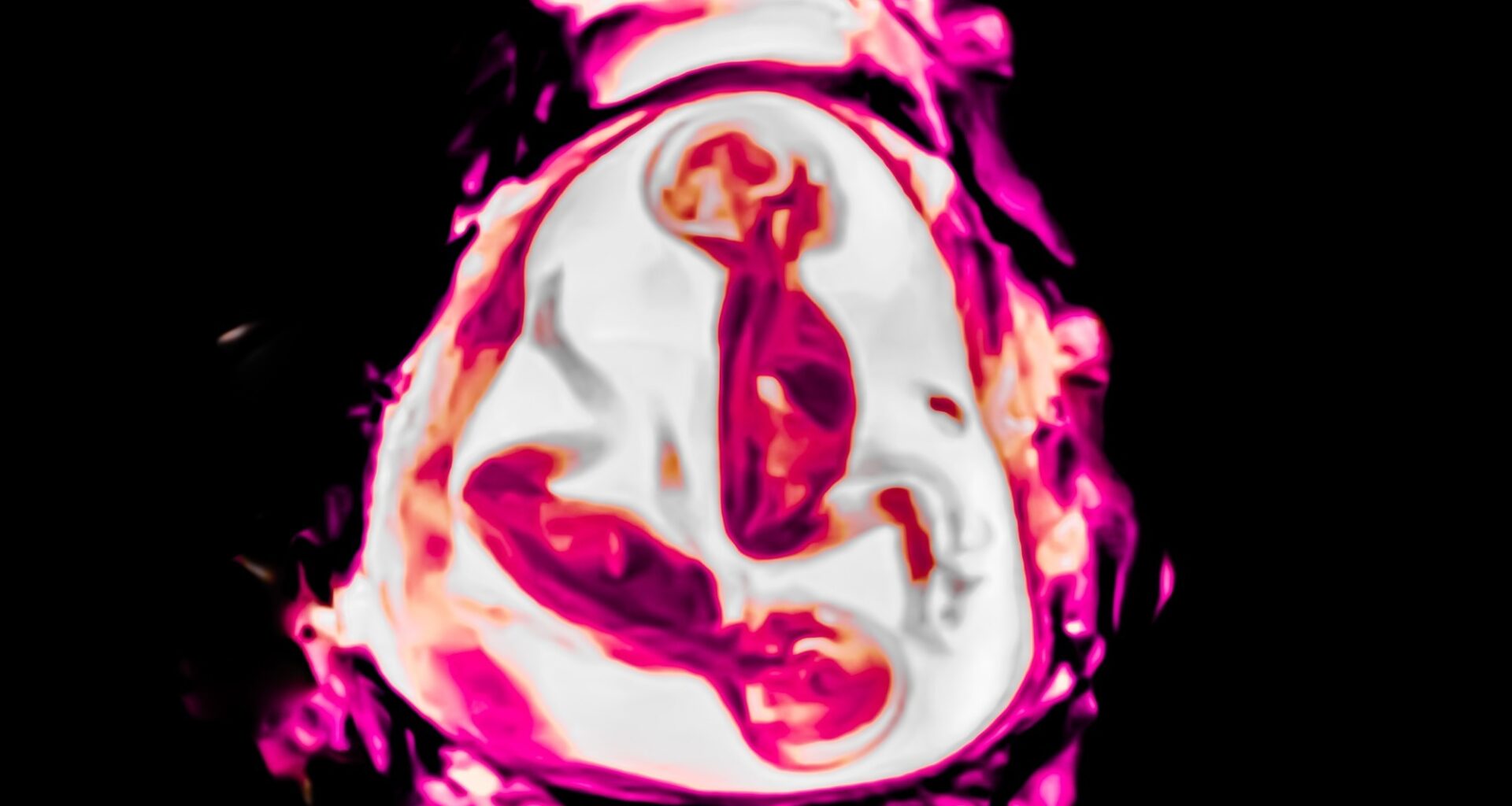 Ultrasography (USG) animal scan image after 30 weeks of pregnancy show normal twin babies.