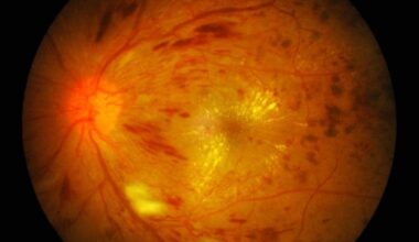 Posture-induced retinal vascular response predicts diabetic retinopathy progression