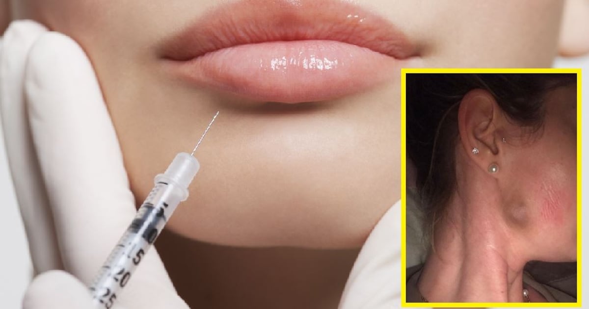 Unregulated dermal filler procedures pose serious threat to health, says medical group – The Irish Times