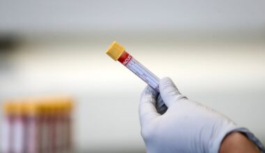 We have a blood test to detect prostate cancer, so why the reluctance to screen? – The Irish Times