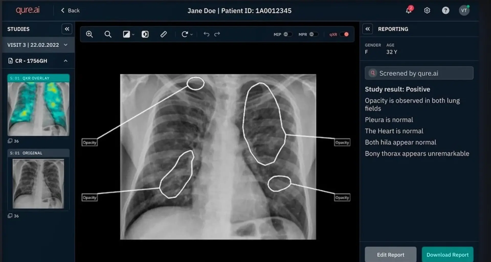 NHS launches AI and robot pilot to spot lung cancer