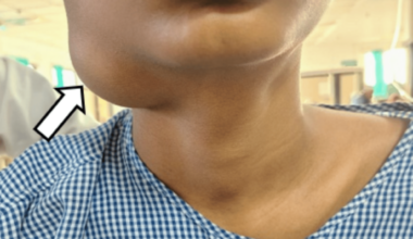 Venolymphatic Malformation Presenting as a Low-Flow Vascular Anomaly: A Case Report