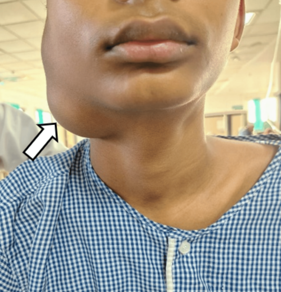 Venolymphatic Malformation Presenting as a Low-Flow Vascular Anomaly: A Case Report