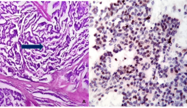 Epithelial Neuroendocrine Neoplasms: Grading Based on the New WHO 2022 Guidelines