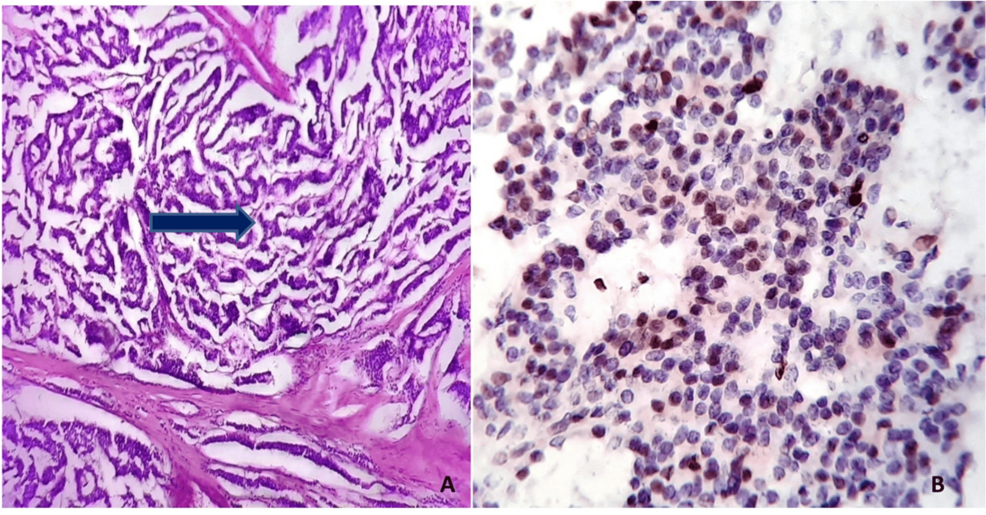 Epithelial Neuroendocrine Neoplasms: Grading Based on the New WHO 2022 Guidelines