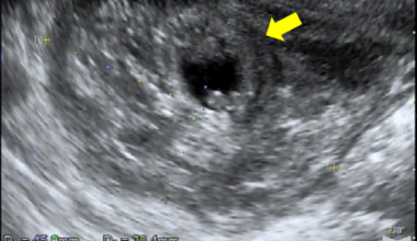 Primary Peritoneal Pregnancy Requiring Conversion From Laparoscopic to Open Surgery Due to Massive Hemorrhage: A Case Report