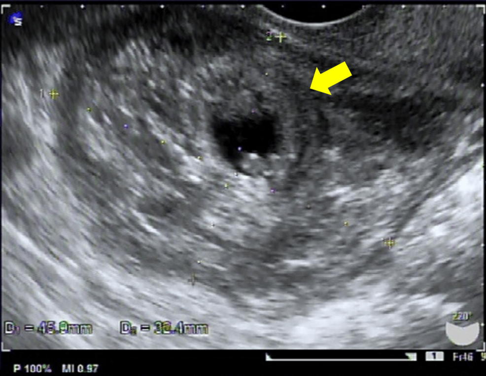 Primary Peritoneal Pregnancy Requiring Conversion From Laparoscopic to Open Surgery Due to Massive Hemorrhage: A Case Report