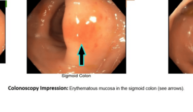 An Unlikely Culprit: Novel Case of Vancomycin Oral Solution-Induced Agranulocytosis