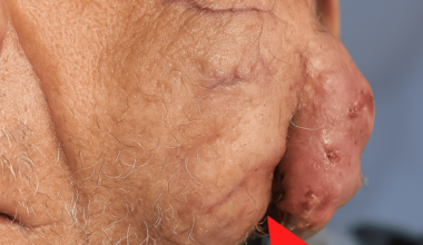 Massive Recurrent Parotid Carcinoma in a 90-Year-Old Patient: A Case Report and Review of Management Strategies