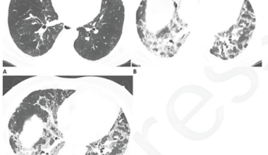 Anesthesia in Patients With Long COVID or Post-infectious Respiratory Sequelae Undergoing Emergency Surgery: Clinical Challenges and Perioperative Strategies