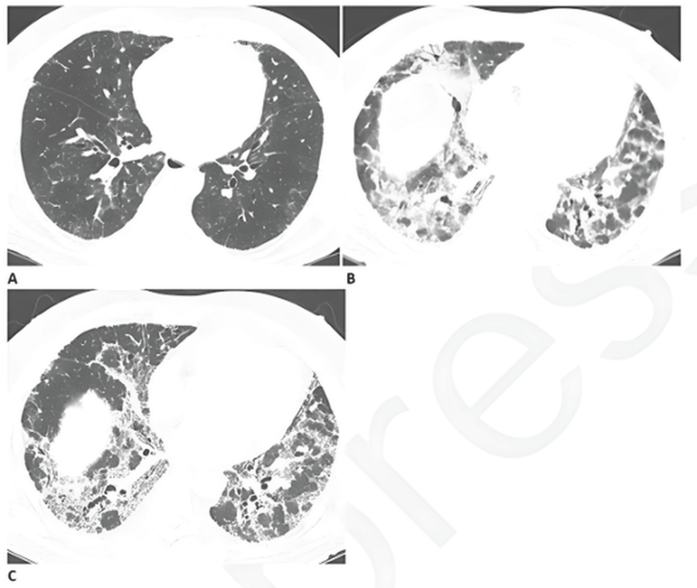 Anesthesia in Patients With Long COVID or Post-infectious Respiratory Sequelae Undergoing Emergency Surgery: Clinical Challenges and Perioperative Strategies