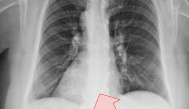 Left-Sided Abdominal Pain Revealing Acute Cholecystitis in Situs Inversus Totalis: Diagnostic Pitfalls and Surgical Considerations