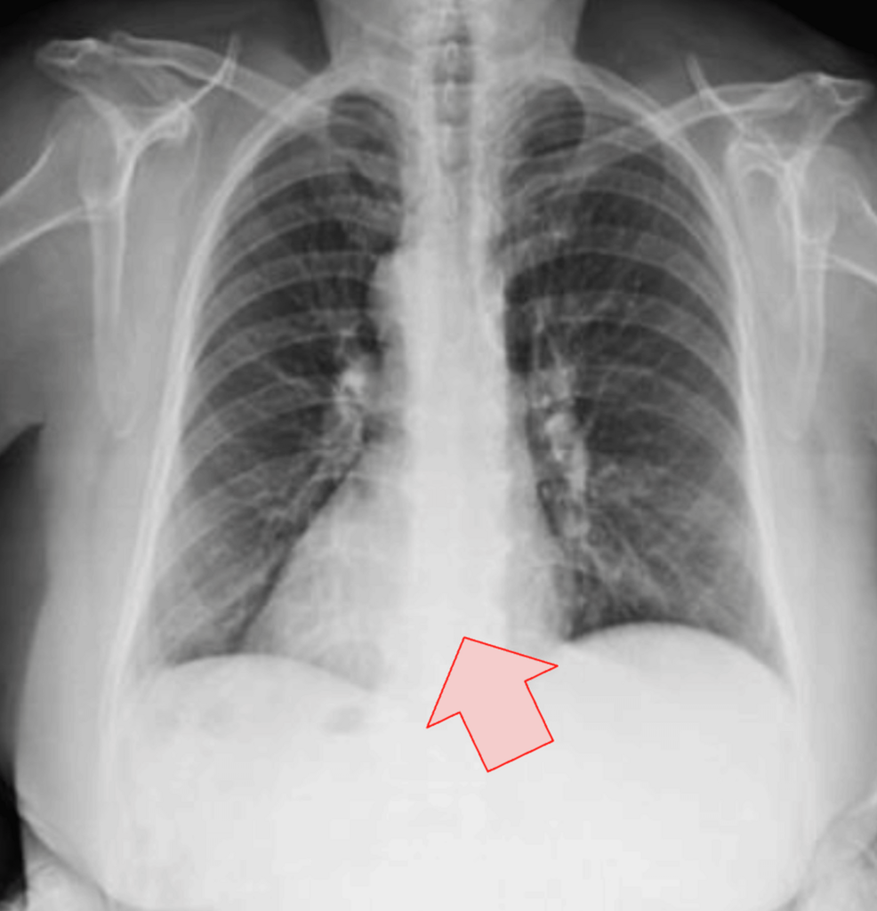 Left-Sided Abdominal Pain Revealing Acute Cholecystitis in Situs Inversus Totalis: Diagnostic Pitfalls and Surgical Considerations