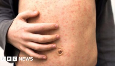 'Fast-spreading' measles outbreak hits several schools in London - BBC