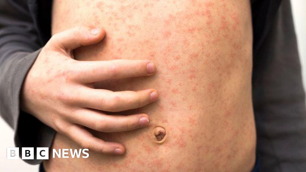 'Fast-spreading' measles outbreak hits several schools in London - BBC