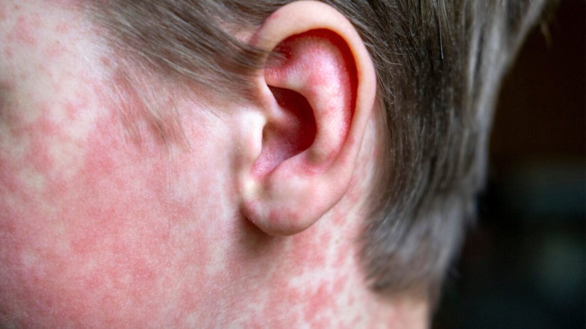 CDC Refuses to Take Blame for Measles Spiraling out of Control