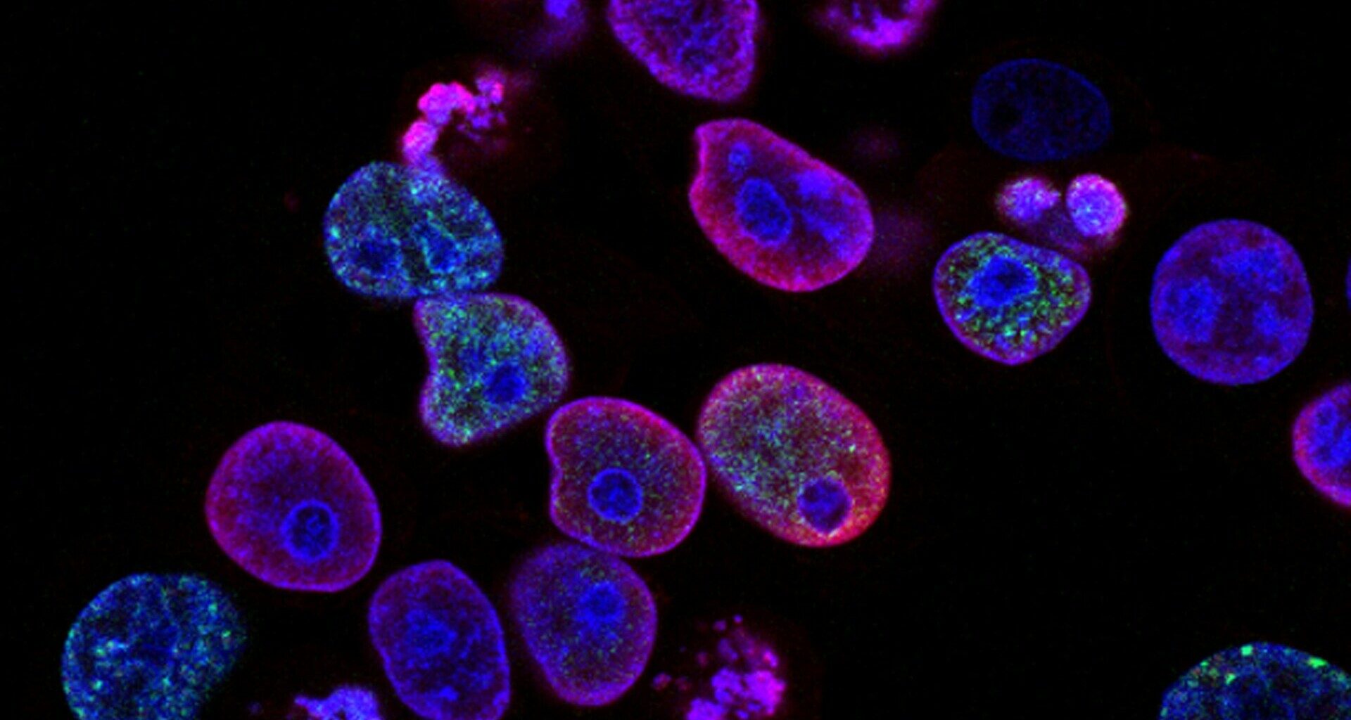 Revolutionary therapy treats ‘untreatable’ blood cancer