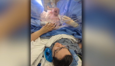 Unplanned C-section doubles risk of 'severe psychological stress' for new moms