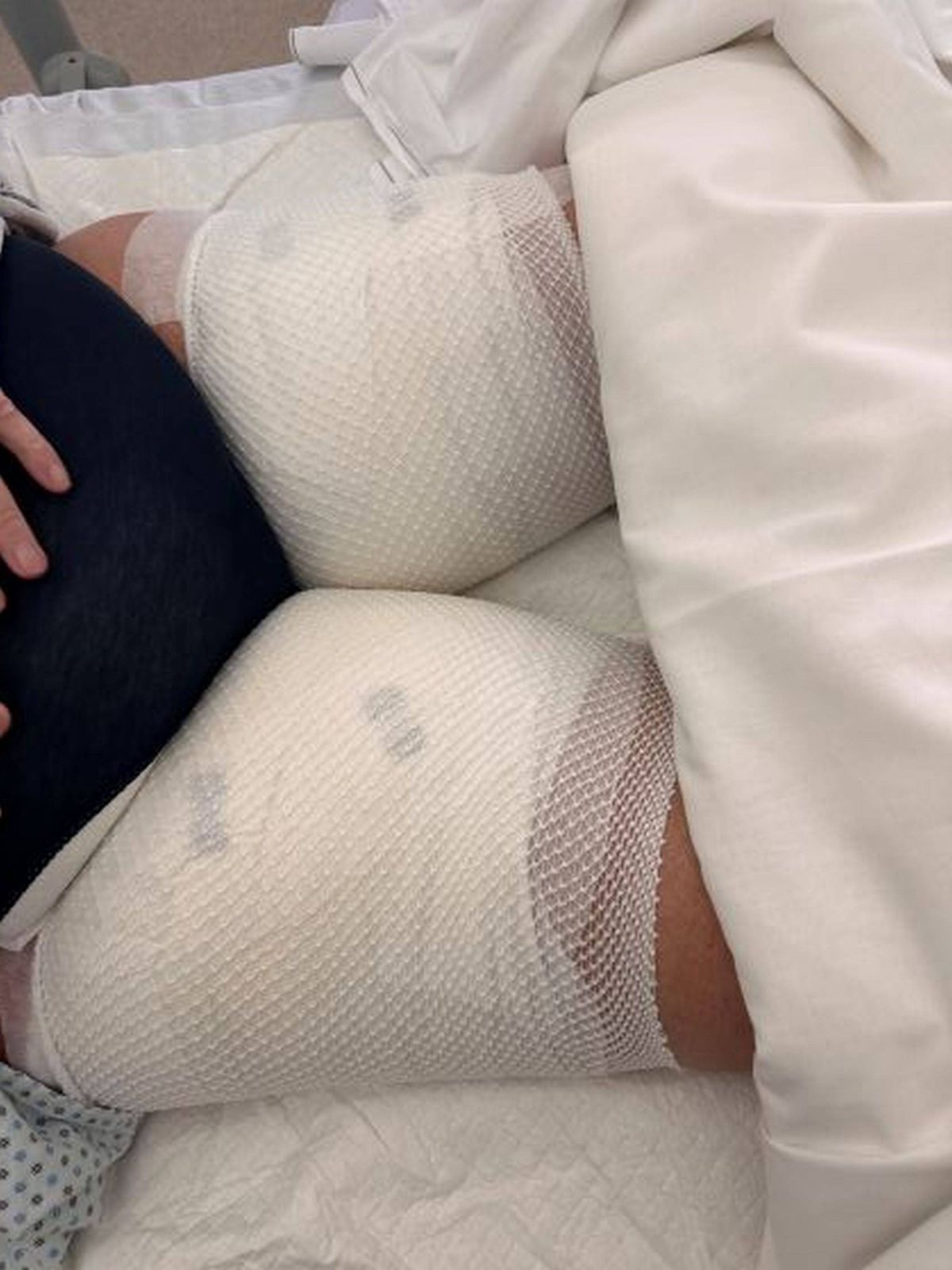 Susan's bandaged burns