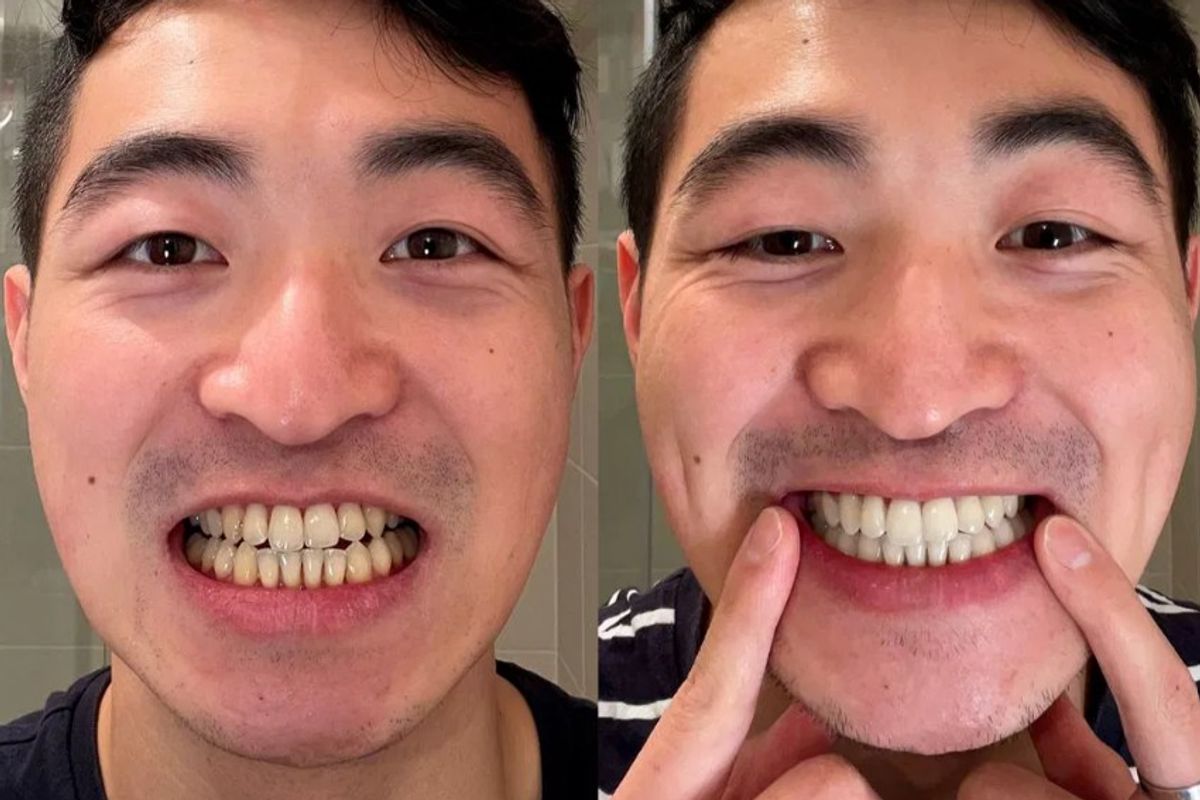 MySweetSmile's teeth whitening products have been praised for transforming teeth from dull to bright and sparkling