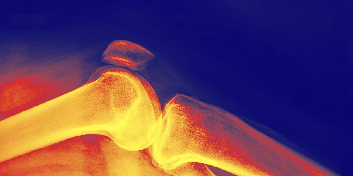 This Is The Best Diet For Stronger Bones During Weight Loss, Per Research