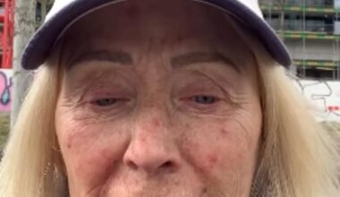 Angie Best has revealed she 'doesn't want to go out in public' or have anyone see her as she suffers from a acne breakout amid her cancer treatment