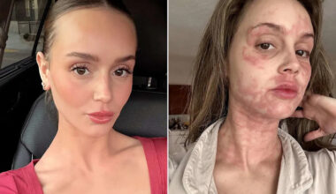 Mikayla Matthews Says She's 'Barely Surviving' as She Reveals the Name of Her Chronic Illness