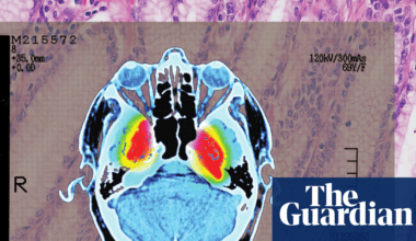 ‘Strong evidence’ of lowered dementia risk: the benefits of shingles vaccination | Well actually