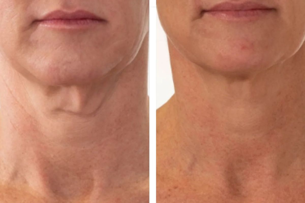 before and after using prai