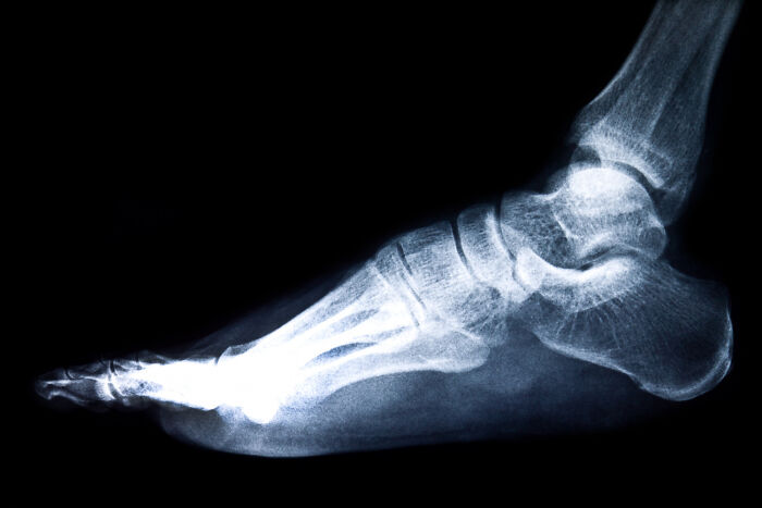 X-ray image of a human foot highlighting bones and joints related to cases of patients faking symptoms in medical settings.