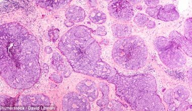 Beverley Callard reveals her mind is 'manic' while preparing to return to work in a health update following her breast cancer surgery