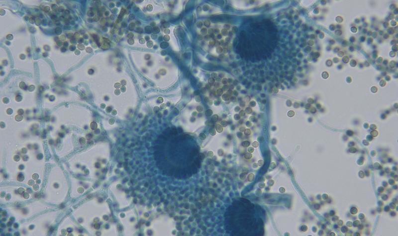 US study shows rising prevalence of fungal infection